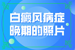 {解決方案}-輕度白癩風(fēng)能治愈嗎?