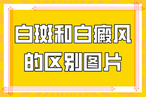 白癩風能治好么-[正確治療]巧治白癜風