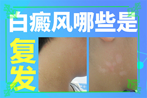 白癲風早期是什么樣,剛發(fā)現(xiàn)的白斑(怎么能看出長啥樣的)