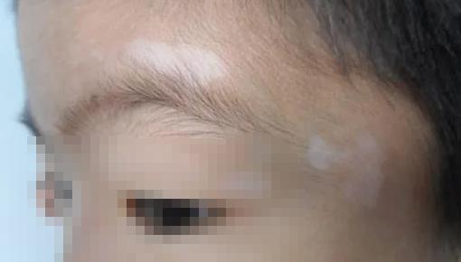 小孩身上有白斑怎么辦？