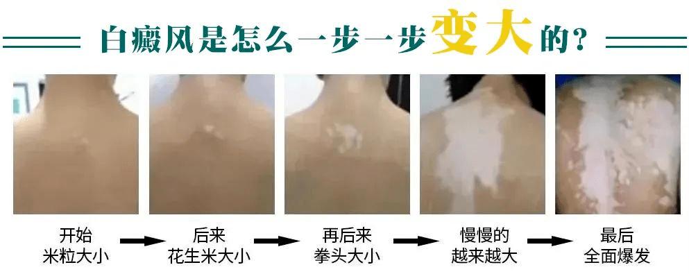皮損面積