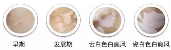 皮損類(lèi)型