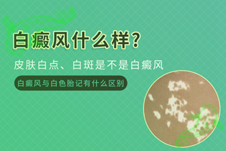 頸部白癩風發(fā)作的因素，原來是生活中容易忽視的細節(jié)