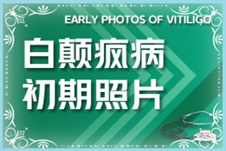 務(wù)川縣白癩風(fēng)初期醫(yī)治方法-三個(gè)要點(diǎn)需謹(jǐn)記-復(fù)色好