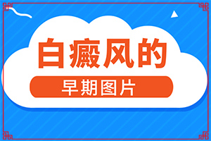 完性白癲瘋圖片[癥狀有哪些]白顛初期癥狀