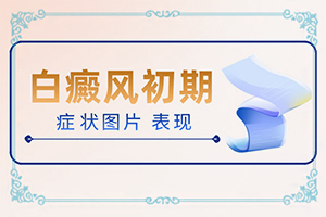 白點癲風(fēng)治療費用[怎樣治療白癜風(fēng)患者]小孩臉上有白斑怎么治療