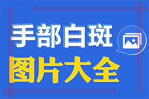 色素脫失白斑可以用地奈德乳膏,正確治療方法有(如何調(diào)節(jié)控制)