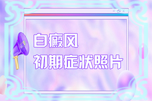 白顛瘋病可以治愈嗎?[治療需要注意什么]小孩白點癲風怎么治療