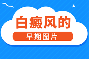 [關(guān)注]初期的輕度白癜風(fēng)應(yīng)該要怎么治療-對(duì)于治療初期的白癜風(fēng)掌握方法很重要