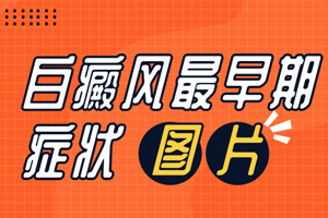 [速度看]早期白癜風(fēng)的癥狀是什么樣子的-我們可以通過什么判斷識(shí)別早期的白癜風(fēng)