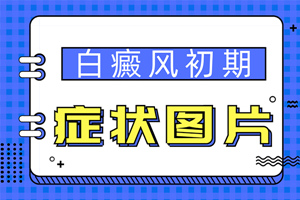 [今日問答]初期白癜風(fēng)的外部癥狀都有哪些-白癜風(fēng)的初期我們可以怎么看出白癜風(fēng)