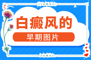 白癩風圖片初期[主要的癥狀是什么]白殿病初期癥狀圖片