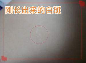 生產后臉上出現一塊塊白斑怎么辦,應該做些(治療后可以恢復嗎)