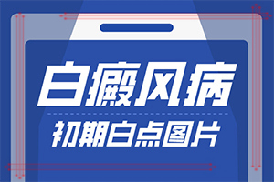 手上有白班是怎么回事[癥狀有什么變化啊]白點癲風的圖片