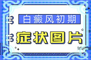 白癲瘋要如何治療[什么方法控制住]專業(yè)治療臉上白癜風醫(yī)院