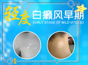 白點(diǎn)癲風(fēng)可以根治嗎[怎么治療比較好]白癲瘋手上能治愈嗎