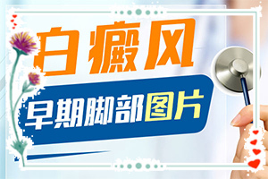 白點癲風(fēng)如何治療了[方法是什么]哪家醫(yī)院治療兒童白斑好