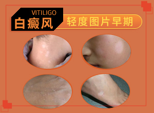 白癜風發(fā)作原因是哪些-額頭上長白斑是什么原因引起的