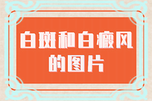 土發(fā)性白點(diǎn)病是什么病有藥治嗎,該如何治療(治白斑怎么得快)