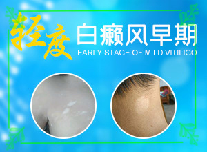 2歲寶寶臉上有白斑是什么原因,具體的誘因有哪些(誘發(fā)因素有哪些)