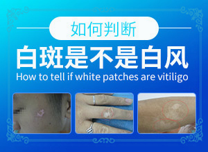 白殿風(fēng)最初圖片,看起來(lái)都是啥樣子的(白斑是什么呢)