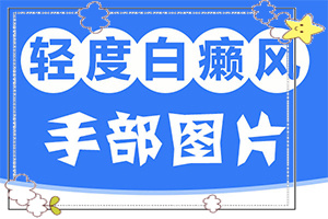 百癲風病癥狀,有哪些診斷常識(消失了又出現(xiàn))