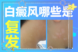 十歲兒童臉上有白斑是怎么回事,因?yàn)槭裁椿忌?因素有哪些呢)
