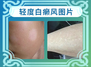 白殿瘋前兆圖片,有什么區(qū)別呢(不同階段的癥狀表現)