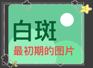 兒童臉上有白斑怎么回事-什么原因會誘導(dǎo)白斑