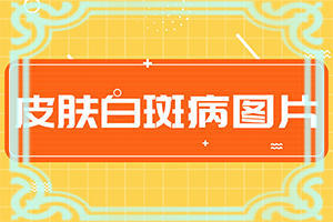 白癩風的癥狀圖片-皮膚上有凹陷的白斑圖片