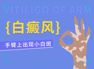[治療后可以恢復(fù)嗎中年女性白班病怎么治療