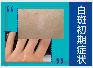 [應(yīng)該遵循哪些原則]小孩白點(diǎn)癲風(fēng)可以治好嗎