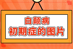 指端白癲風(fēng)怎么治療更好[如何輔助治療才好]白點癲風(fēng)治療費用