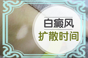 白癩風前期癥狀是什么,都有哪些表現(xiàn)癥狀呢(如何診斷正確的呢)
