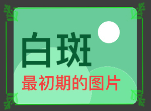 臉上好端端的長了白斑,會(huì)有什癥狀(幾個(gè)基本表現(xiàn))