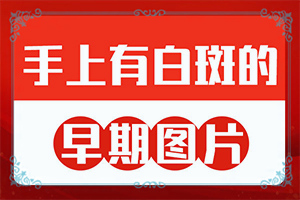 [白斑治療常識有哪些]那里看白癲效果好