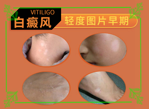 我想說(shuō)皮膚用藥后留下的白斑怎么治（如何比較好的治療）