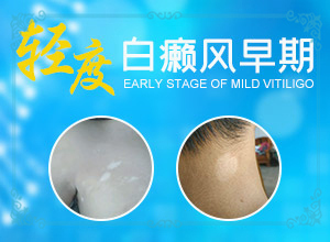 外傷引起瞳孔白斑能治療好嗎。,常見誘因有哪些(發(fā)生因素有哪些)
