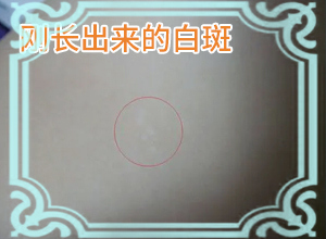 白班用什么藥涂[如何才能診療]腰部的白殿風好治療嗎?