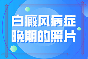 輕微白癩風圖片[發(fā)生時有什么癥狀]初期白癲的癥狀是什么