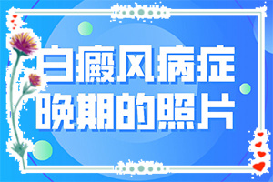 手上起白斑是什么原因-誘發(fā)因素有哪些